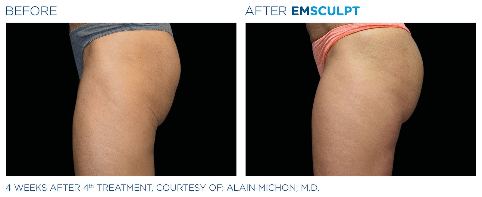 Emsculpt Glutes 01