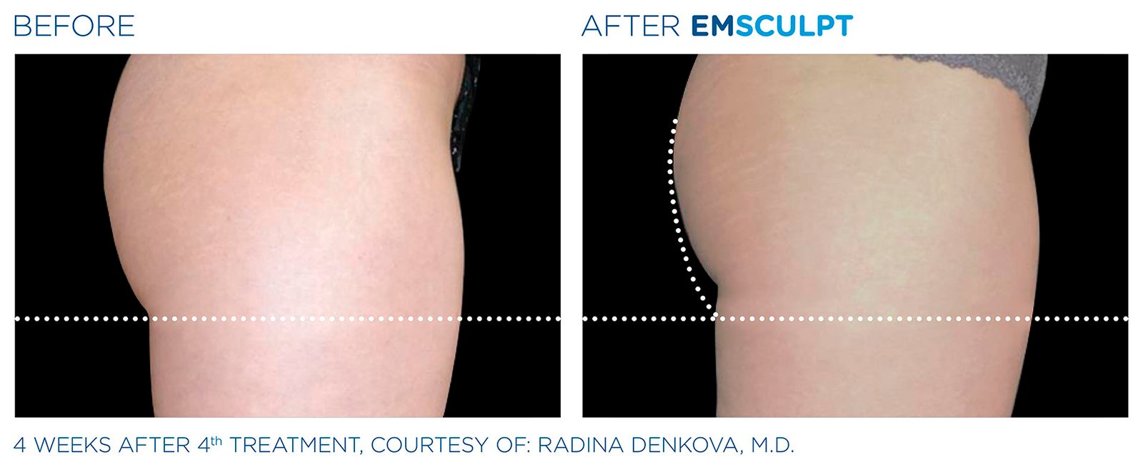 Emsculpt Glutes 02