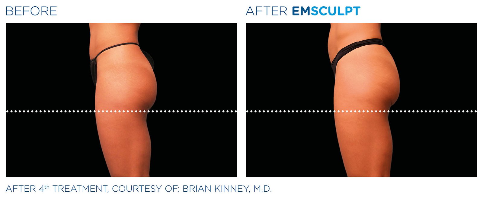 Emsculpt Glutes 03