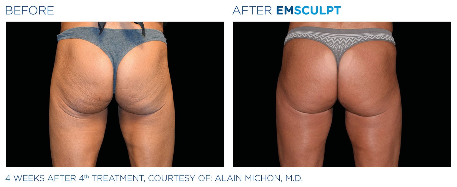 Emsculpt Glutes 04