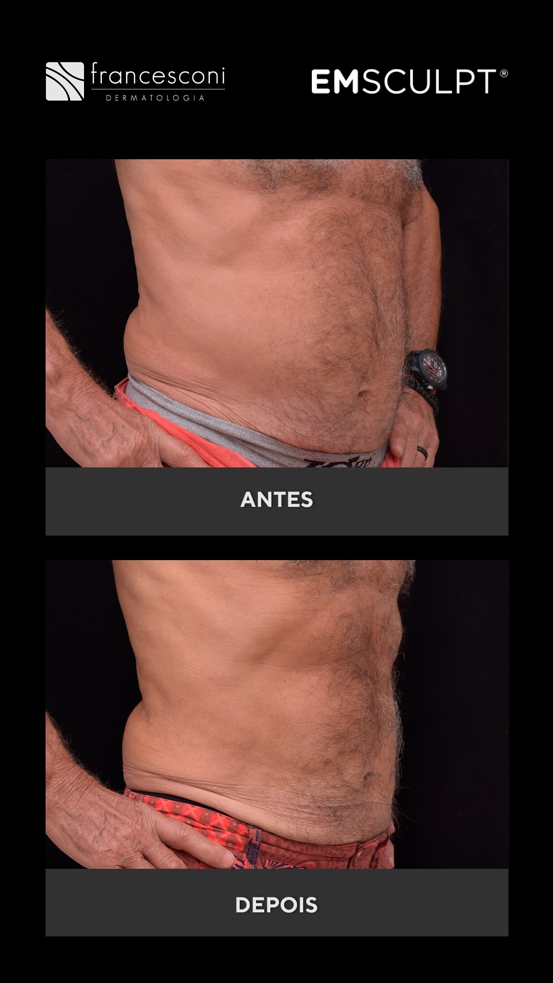 EMSCULPT - Antar Fontoura (vertical) 2