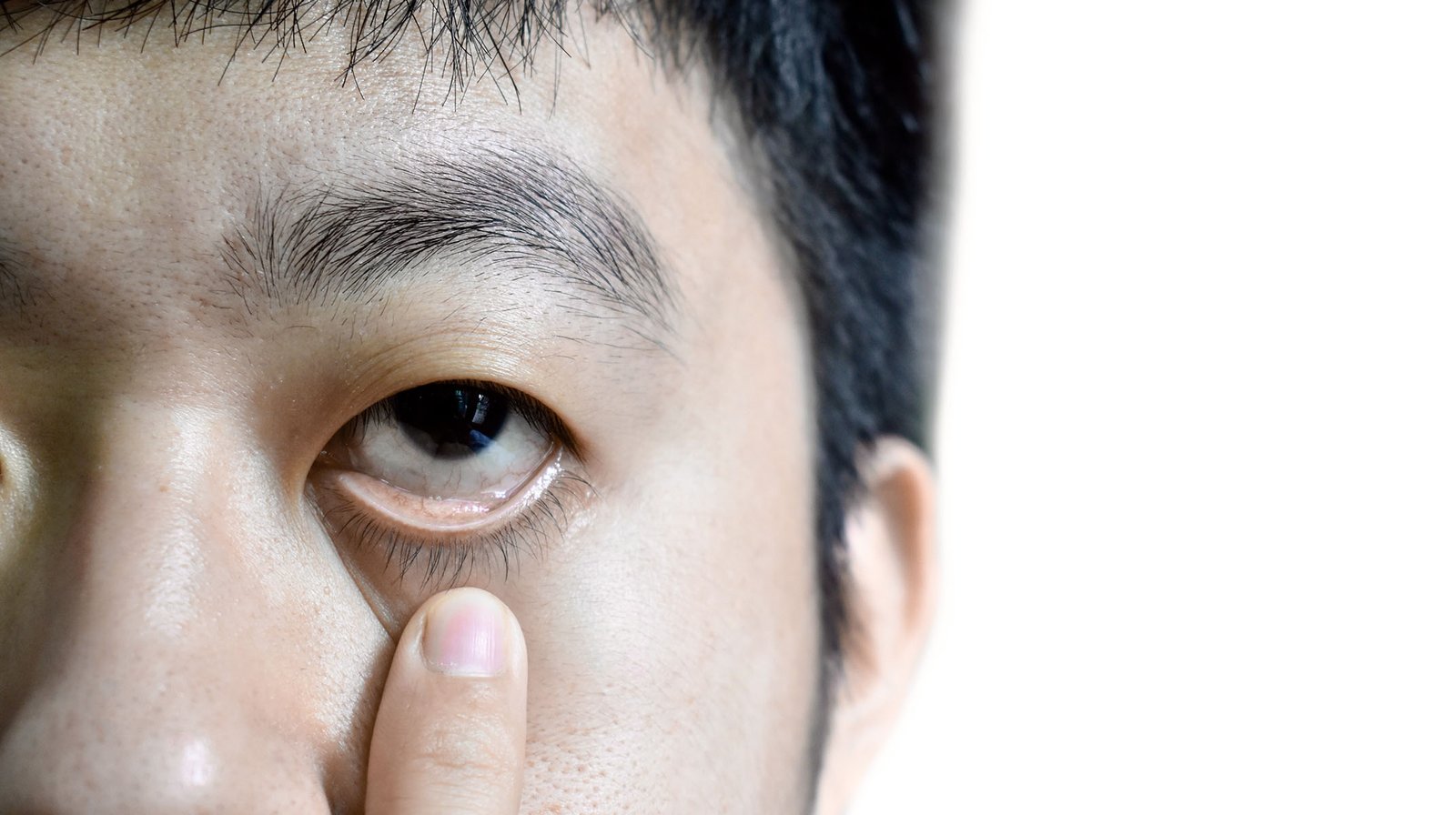 Pale,Skin,Of,Asian,Man.,Sign,Of,Anemia.,Pallor,At