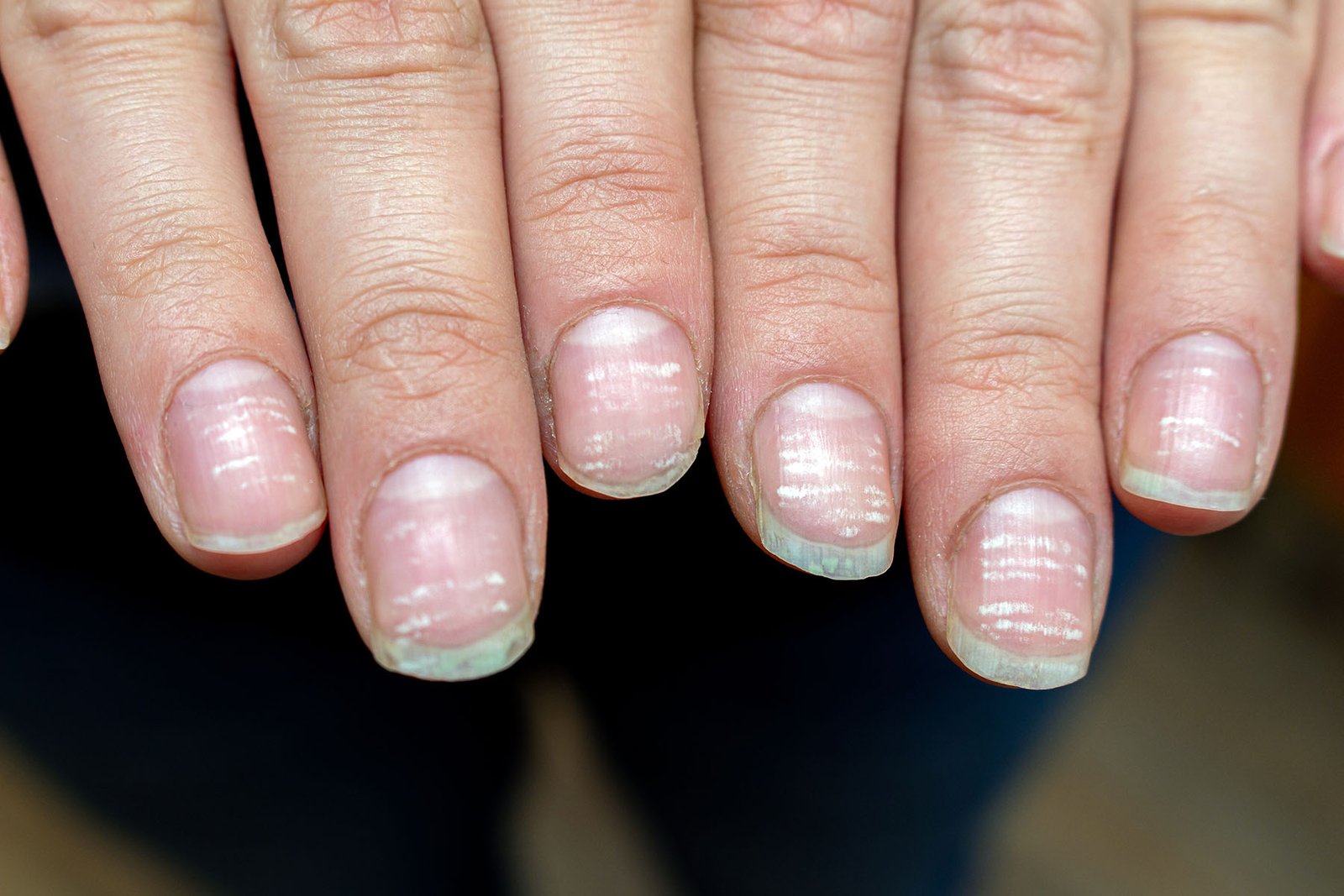 Vitamin,Deficiency,Avitaminosis,Anemia,Nail,Problem,With,White,Dots